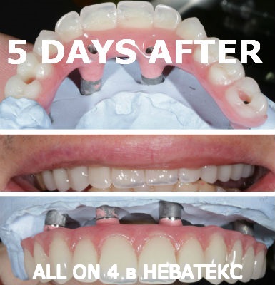 улыбка после имплантации алл он фо фото улыбка после имплантации алл он фо